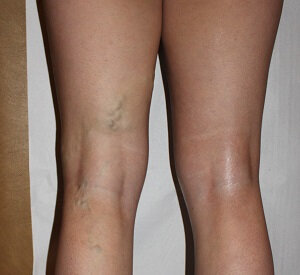 My legs before applying NanoVein