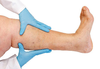 NanoVein used to treat varicose veins, thrombosis, related diseases