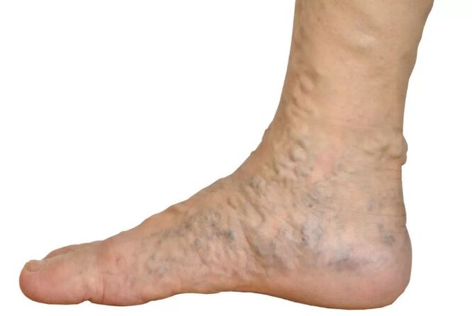 Veen diseases in the legs
