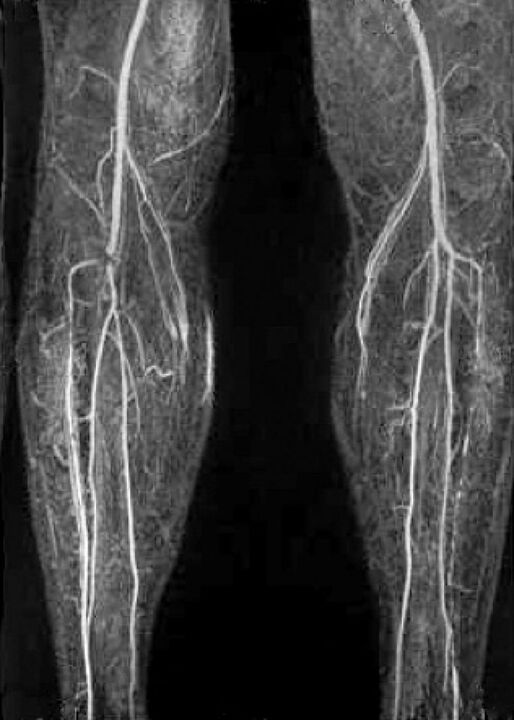X -ray vascular