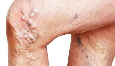 The main manifestations of varicose veins in the legs