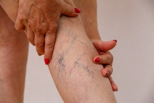 causes of varicose veins