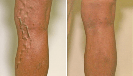 varicose veins in stages 1 and 3 of development