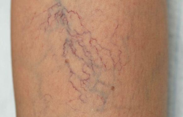 varicose veins on the legs in women