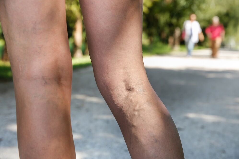 varicose veins in the legs
