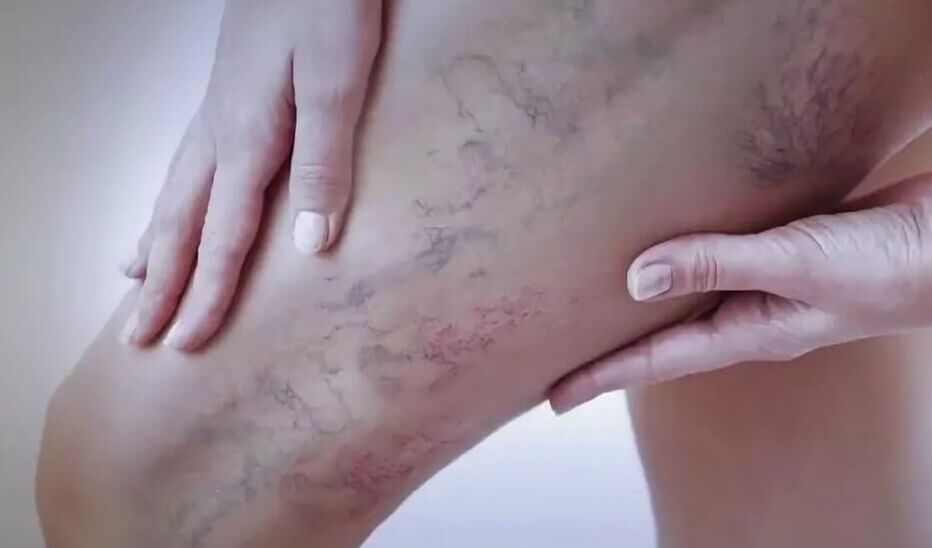 Stars in the legs with varicose veins