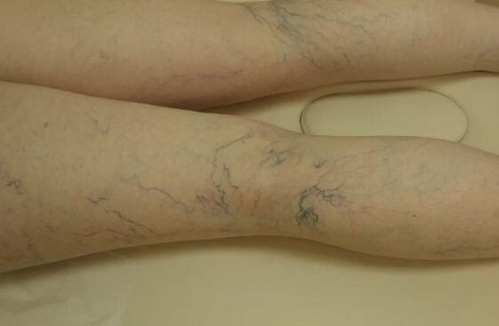 Variced Stars on the legs