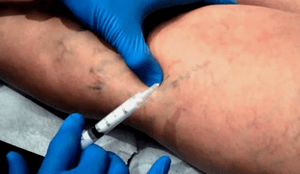how to treat varicose veins in men