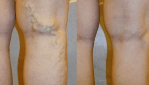 signs and symptoms of varicose veins in the legs in men