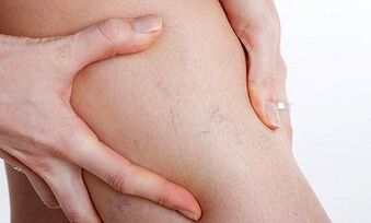 reasons for developing varicose veins in the legs