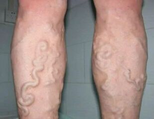 Grade 3 varicose veins on the legs