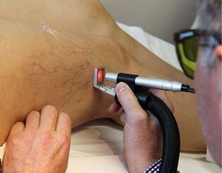 contraindications for the treatment of varicose veins with laser