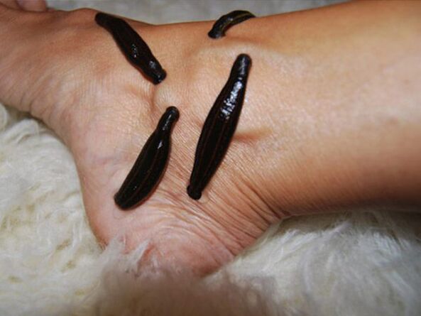 Treatment of varicose veins in the legs with leeches