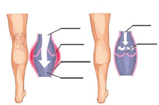 healthy and painful veins in the legs