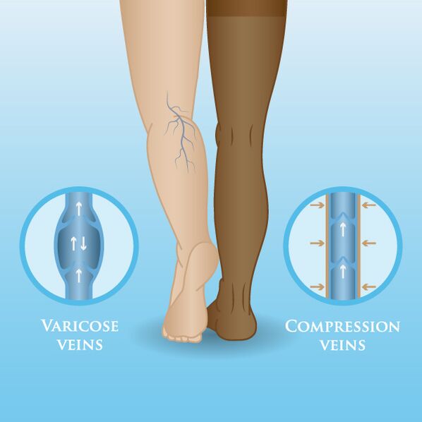 Effects of compression garments on varicose veins in the legs