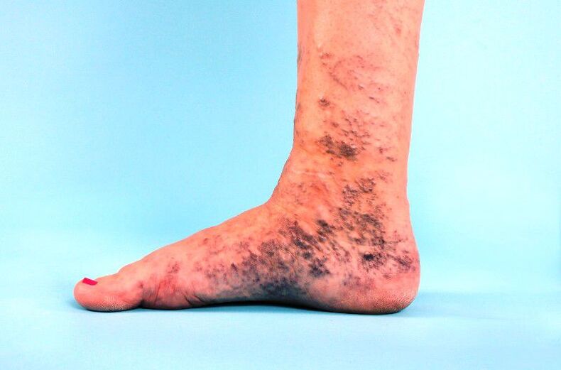 neglected varicose veins in leg
