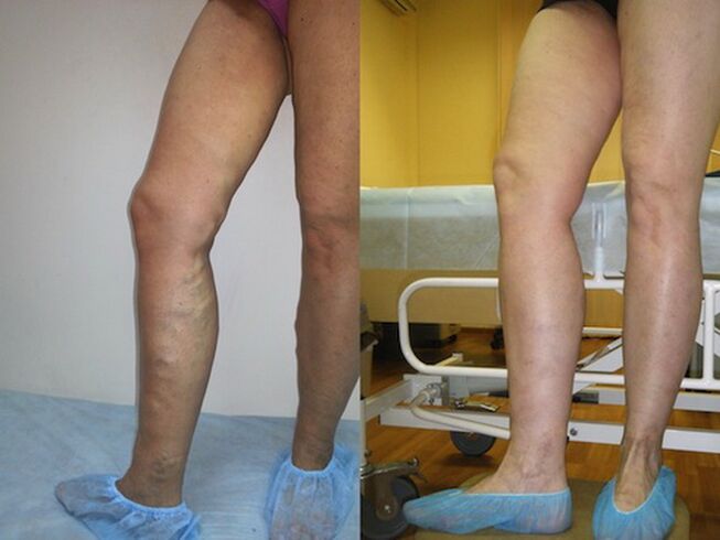 Legs before and after laser treatment for varicose veins