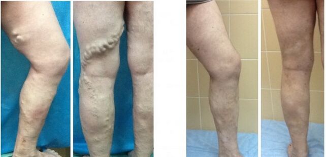 Legs before and after radiofrequency obliteration of veins with varicose veins