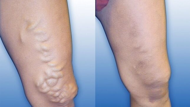 Legs before and after treatment for severe varicose veins