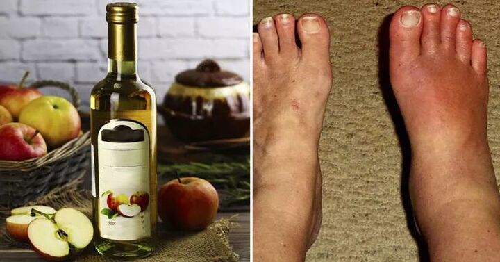 apple cider vinegar for foot swelling