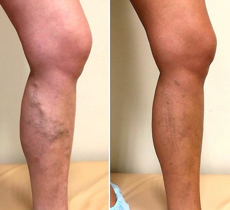 before and after using apple cider vinegar for varicose veins