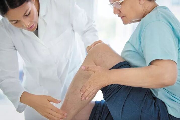 treatment of varicose veins by a doctor