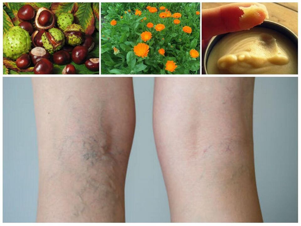 varicose veins and folk remedies for their prevention