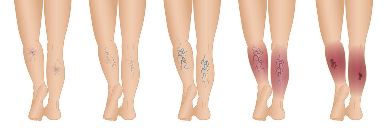 Stages of varicose veins of the lower extremities