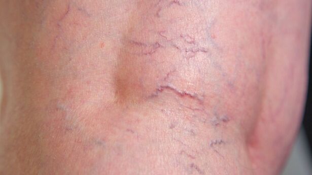 Signs of lower extremity reticular varicose veins - dilation of fine veins and vascular mesh