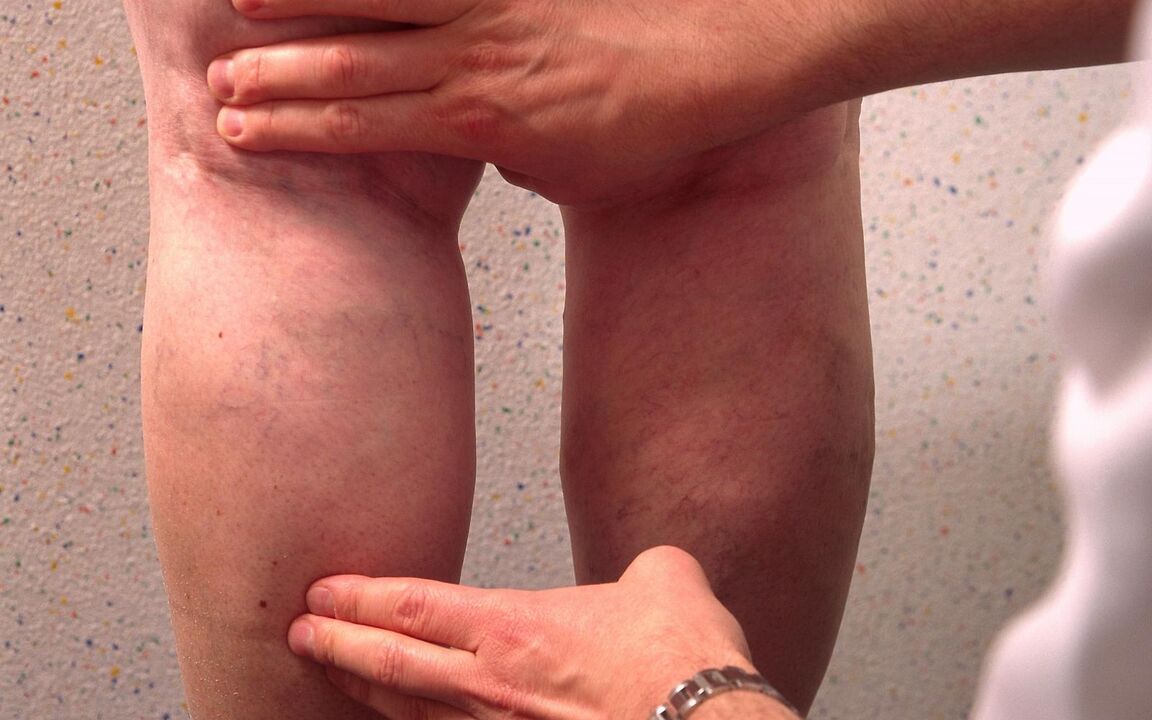 the doctor examines the legs for varicose veins