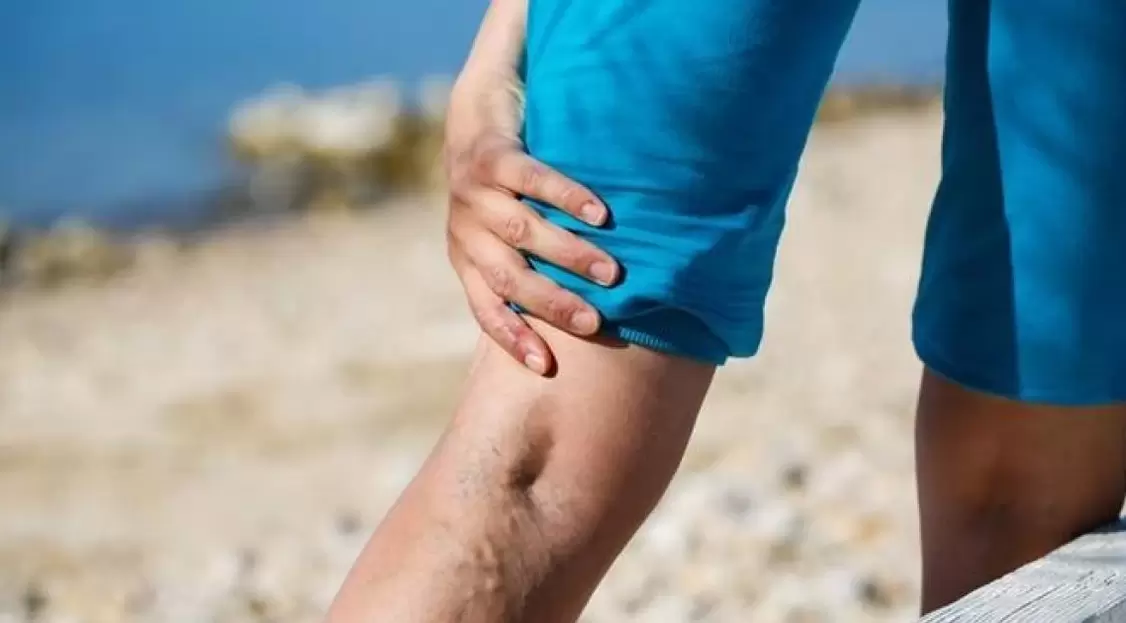 Protruding blue veins on your legs are a sign of varicose veins