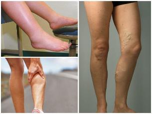 the effects of varicose veins