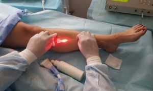 varicose veins surgery