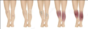 Varicose veins of the lower extremities stage
